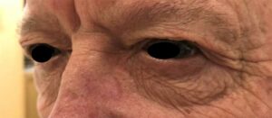 Chirurgie des paupières supérieures