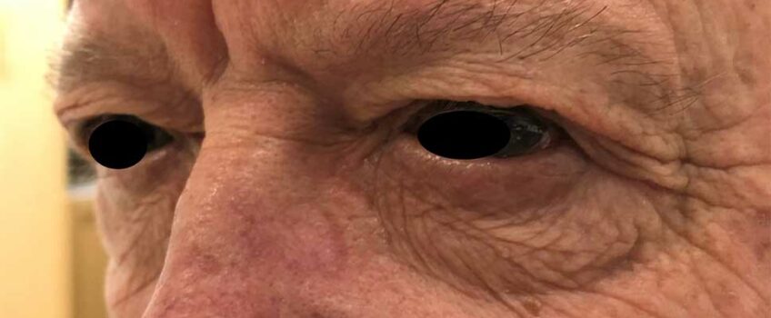 chirurgie-paupieres-superieures-etampes-dr-senechaut