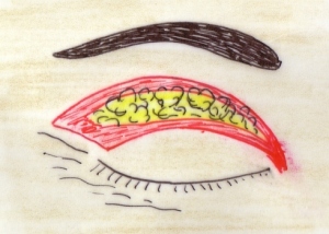 Chirurgie esthétique des paupières - Docteur Senechaut