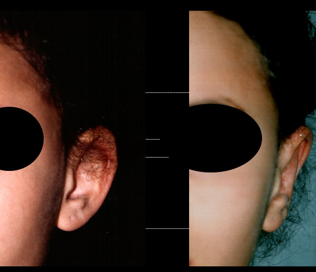 chirurgie-esthetique-des-oreilles-dr-senechaut-02