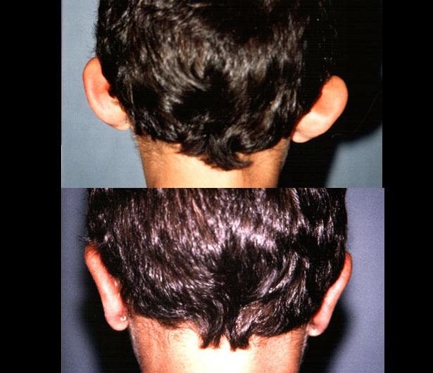 chirurgie-esthetique-des-oreilles-dr-senechaut-04