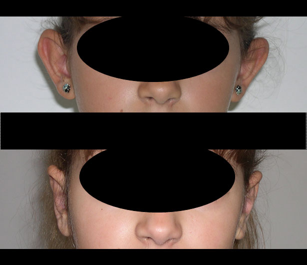 chirurgie-esthetique-des-oreilles-dr-senechaut-05