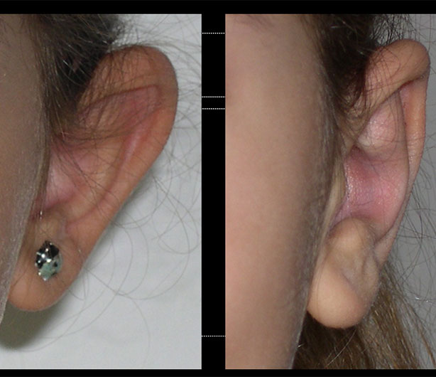 chirurgie-esthetique-des-oreilles-dr-senechaut-06