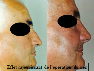 chirurgie-esthetique-du-nez-avant-apres-29